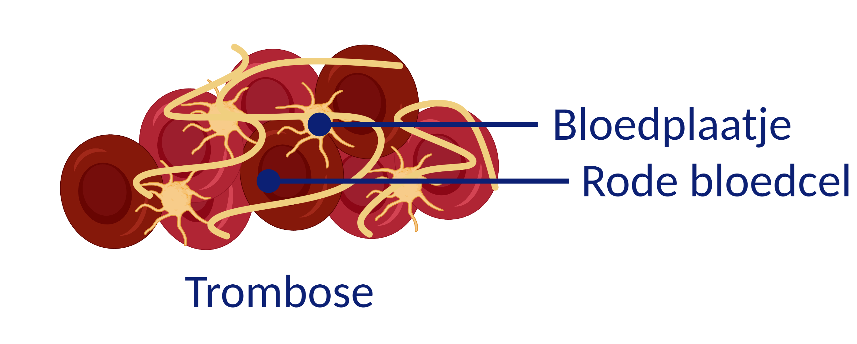 trombose bloedplaatje en rode bloedcel